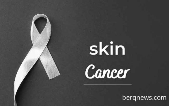 Skin Cancer: Causes, Symptoms, and Prevention
